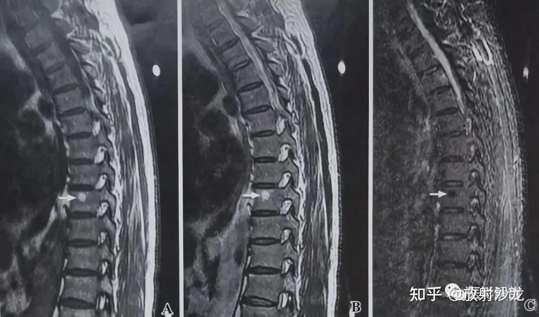 正常胸、腰椎的MRI解剖 - 知乎