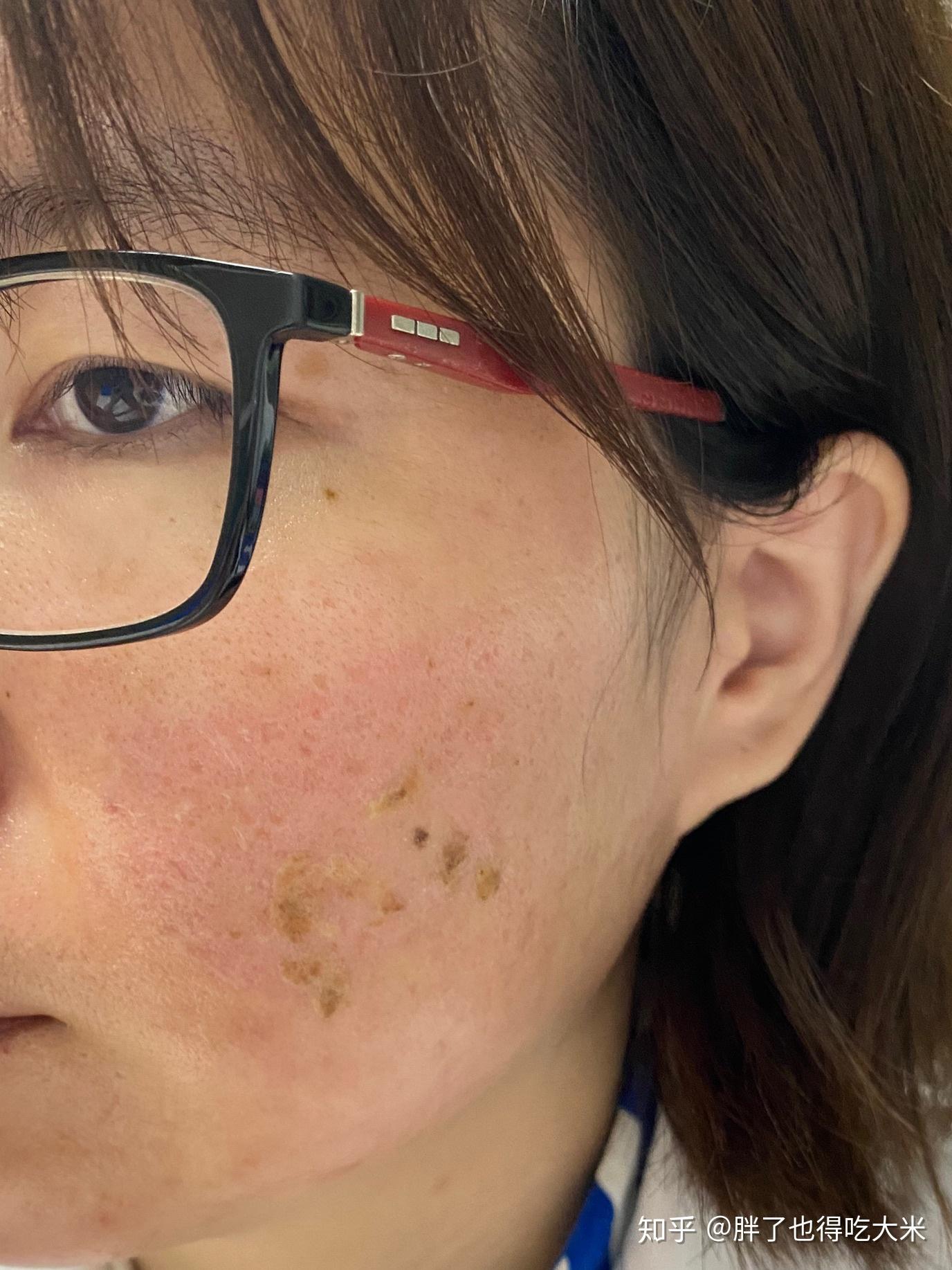 记录一下自己的微针治疗经历啊补充副题0929铒激光已做二次补充副题