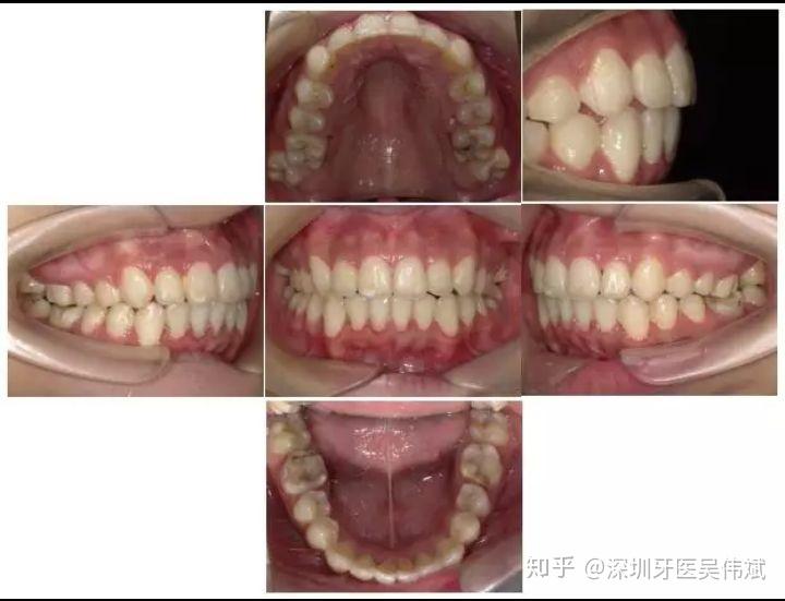 總結分析ii期綜合固定正畸治療6個月後磨牙達中性關係上頜推磨牙向後i