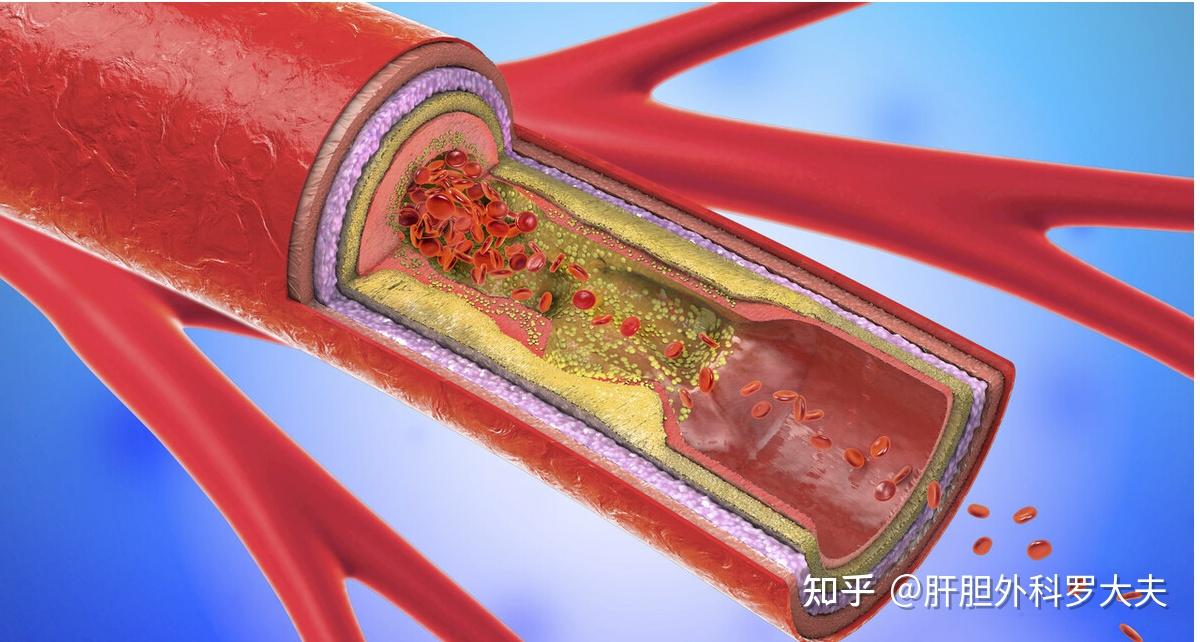 如何逆转动脉粥样斑块 v2-9a32f709a55bebb6b1d17aaee4d31ccd_r.jpg