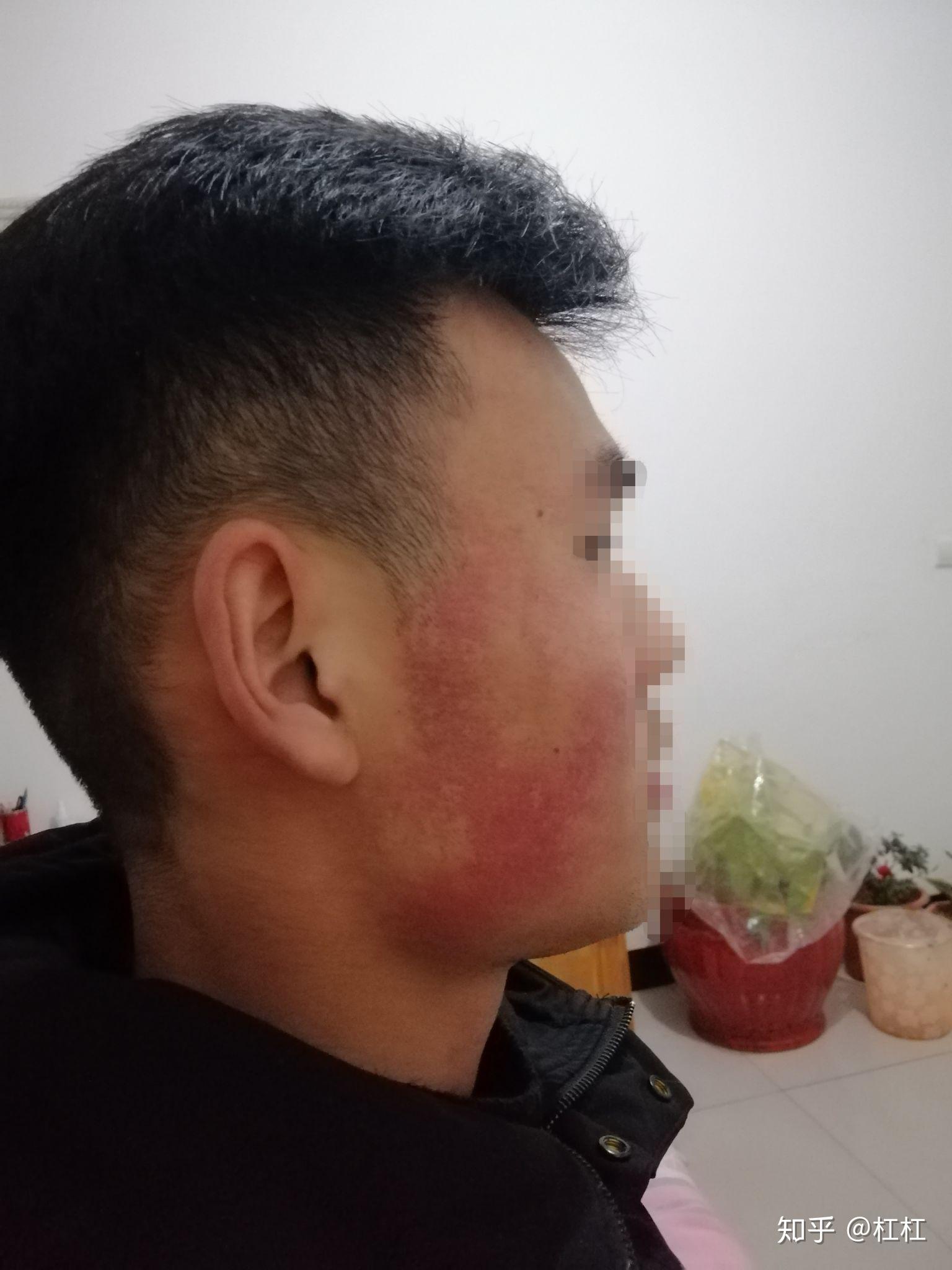 脸颊两侧红有鸡皮疙瘩(脸颊两侧鸡皮疙瘩是怎么回事)