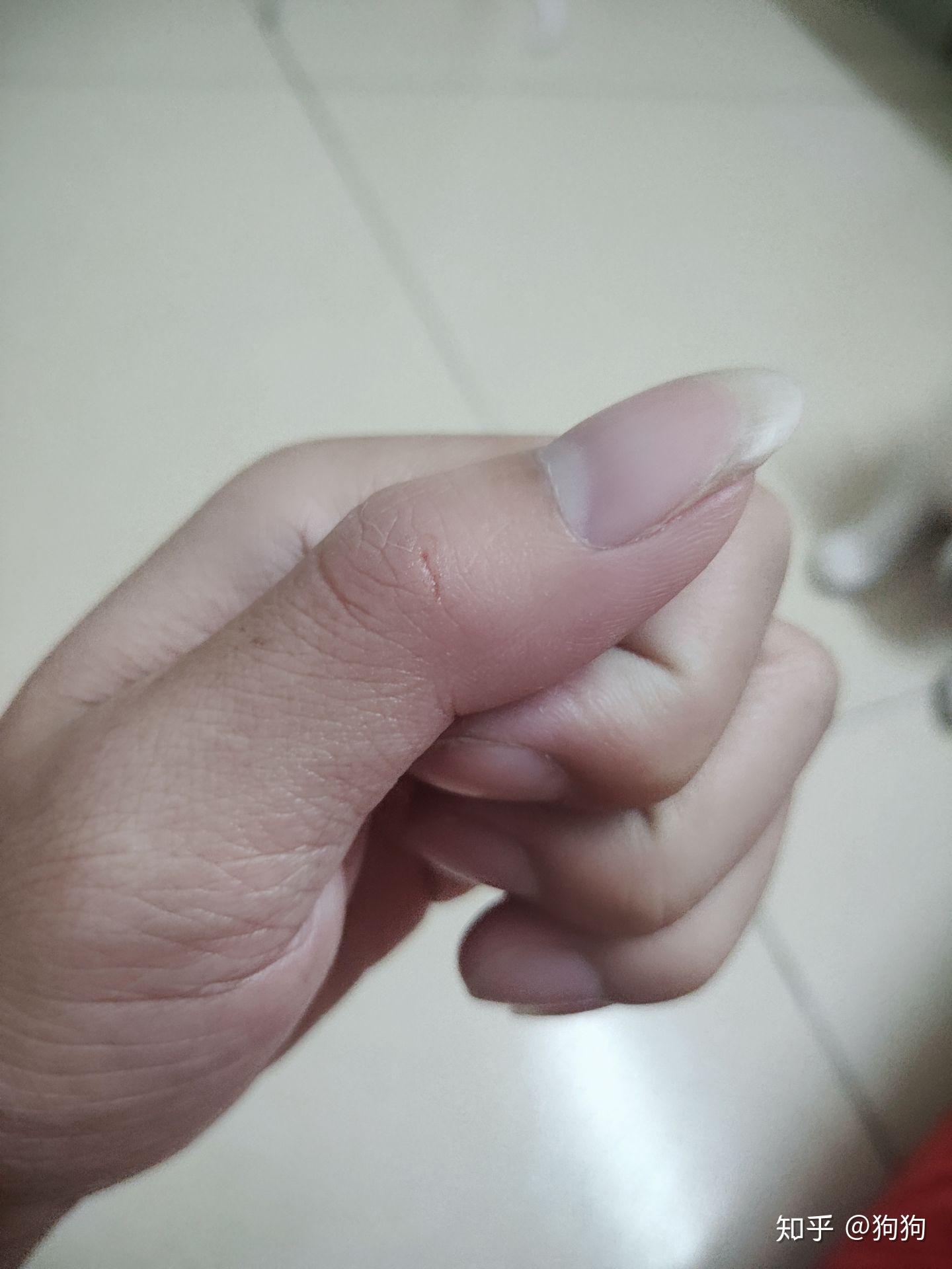 今天回来被我家养的博美牙齿划伤了破了一点点皮我挤出了血用清水清洗