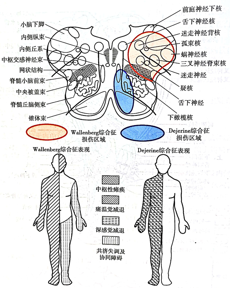 脊髓丘腦系,內側丘系#多見於小腦下前動脈閉塞延腦背外側wallenberg