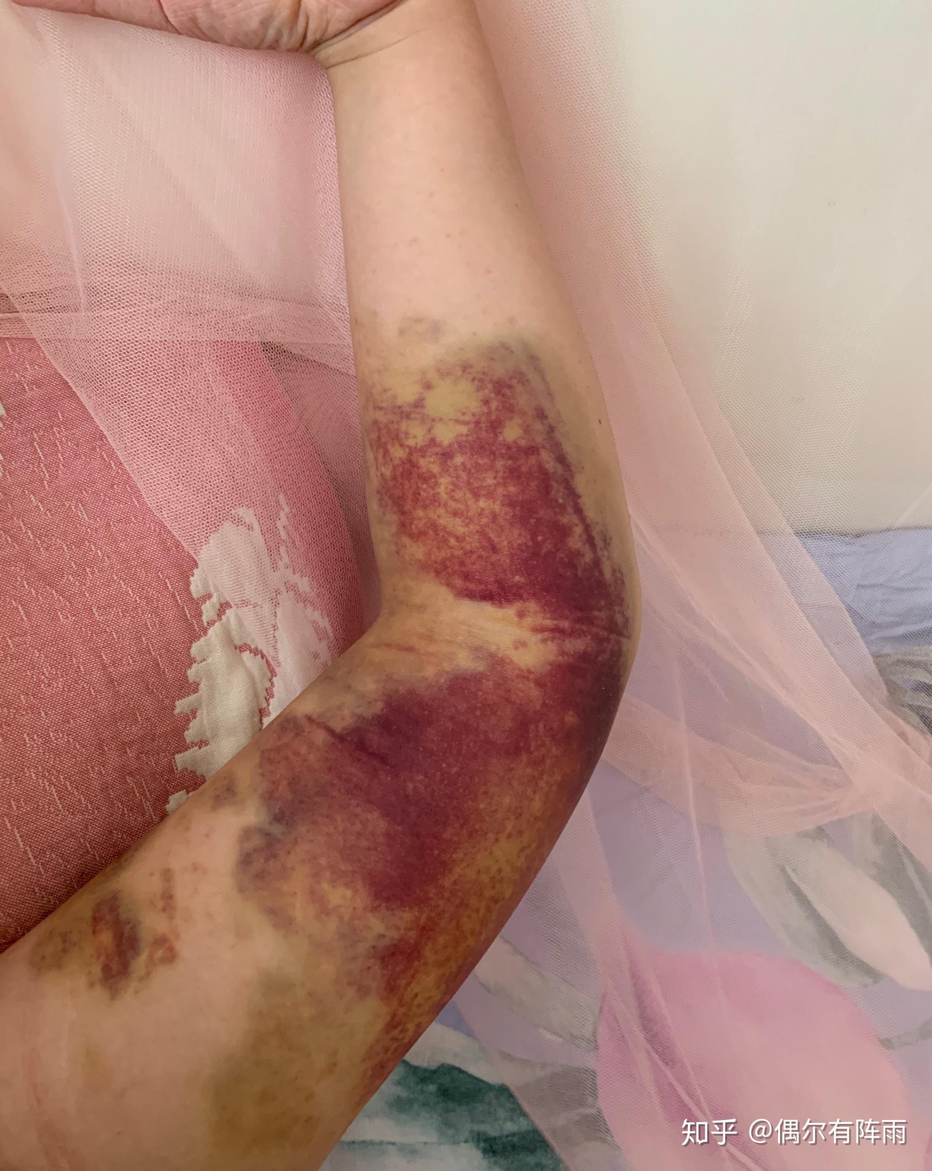 拍痧拍成这样有知道的吗求解惑