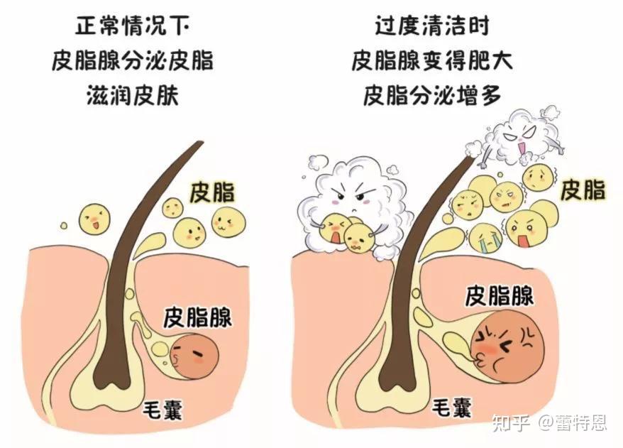 皮脂腺分泌旺盛 zhuanlan.zhihu.com