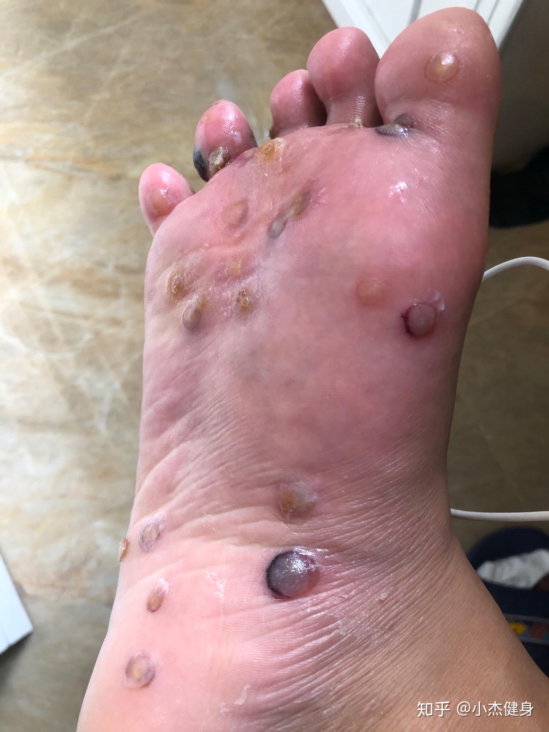 跖疣病魔根除的漫长过程,抵抗!