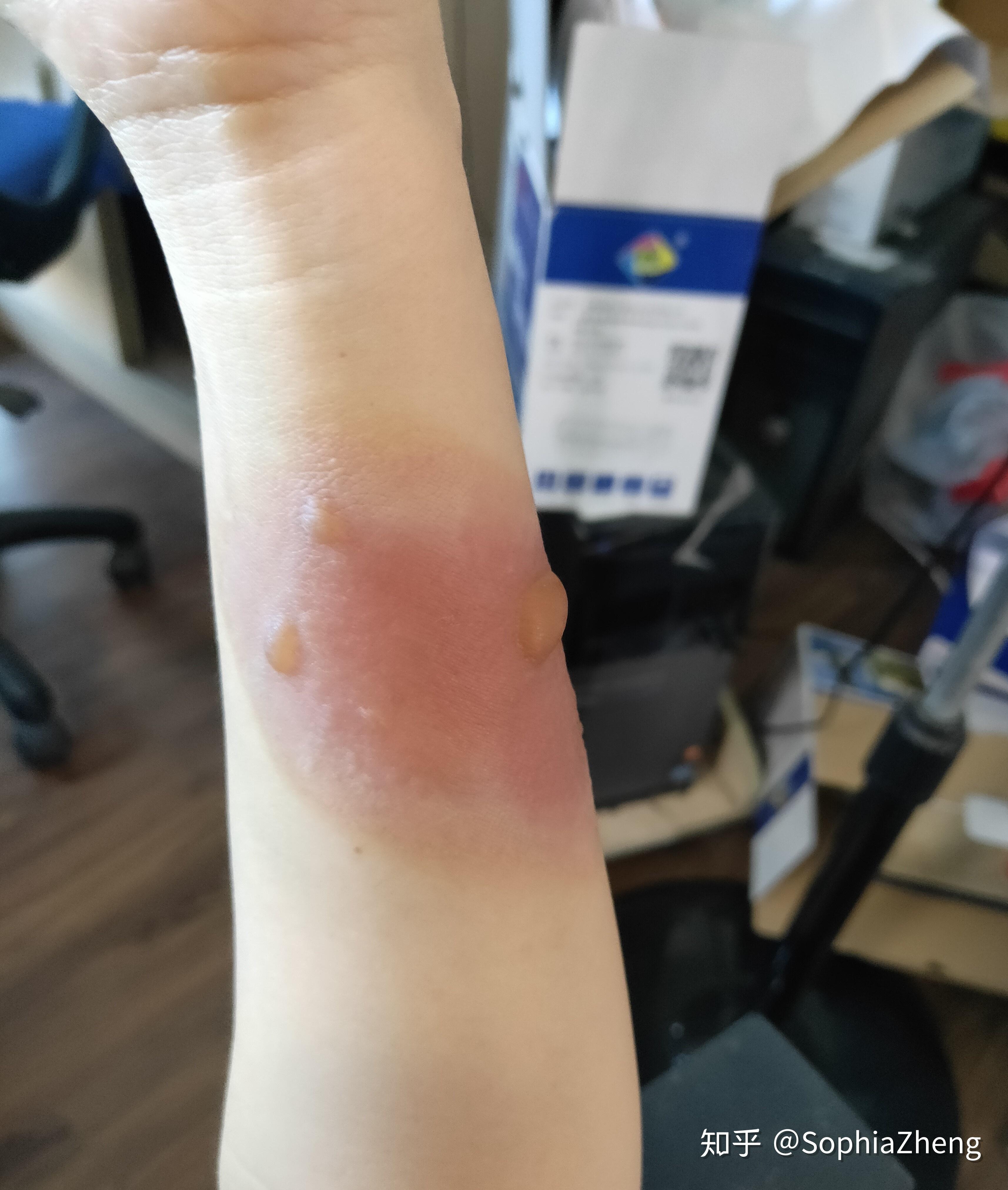 如何处理蒸汽高温烫伤?今天我来说一说. - 知乎