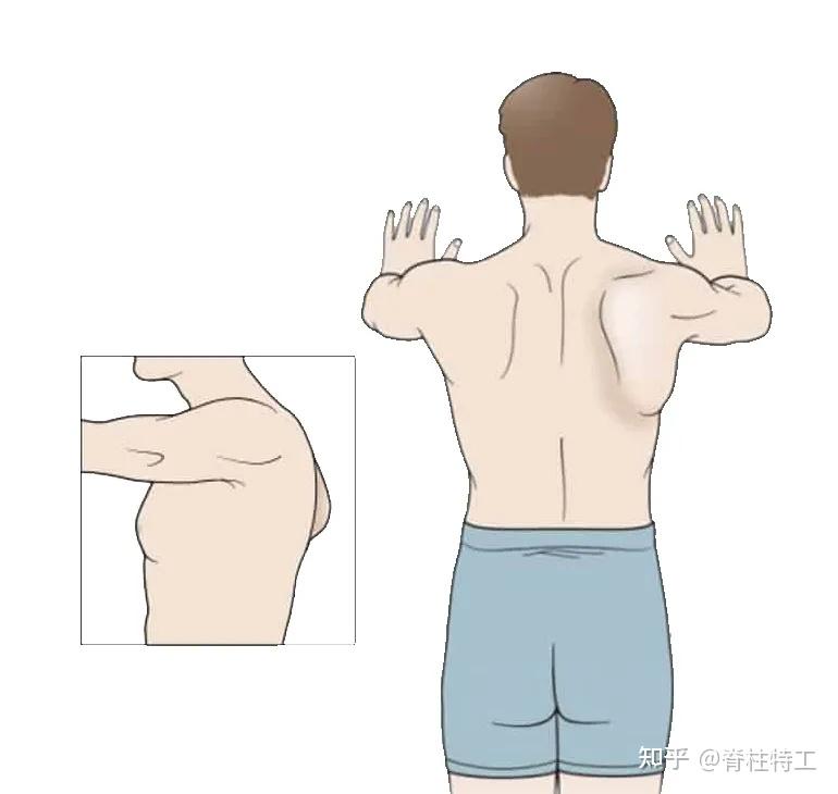 翼状肩让你的背看起来又驼又厚如何矫正
