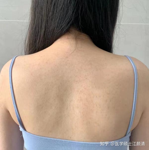 背部痘痘太丑了,如何才能真正的祛除背部痘痘?医学硕士教你正确去除背部痘痘的方法!后背痘还得靠这4步! - 知乎