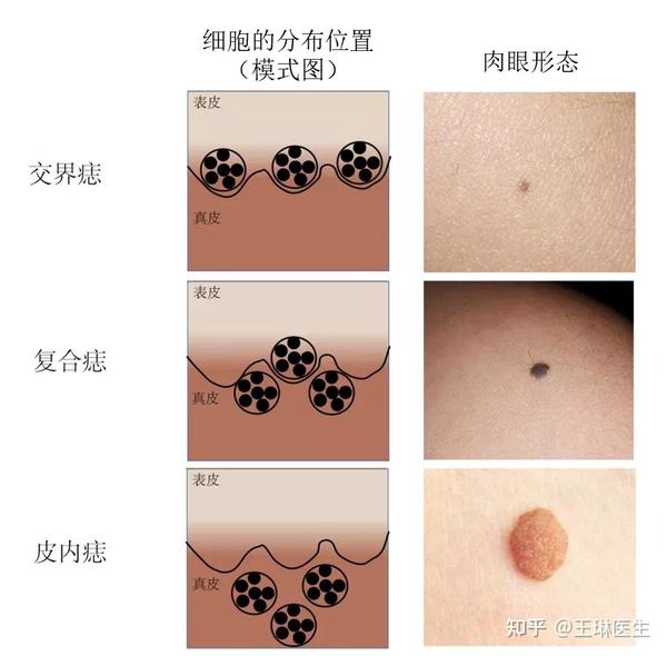 痣与健康:发生黑色素瘤的六个危险因素 - 知乎