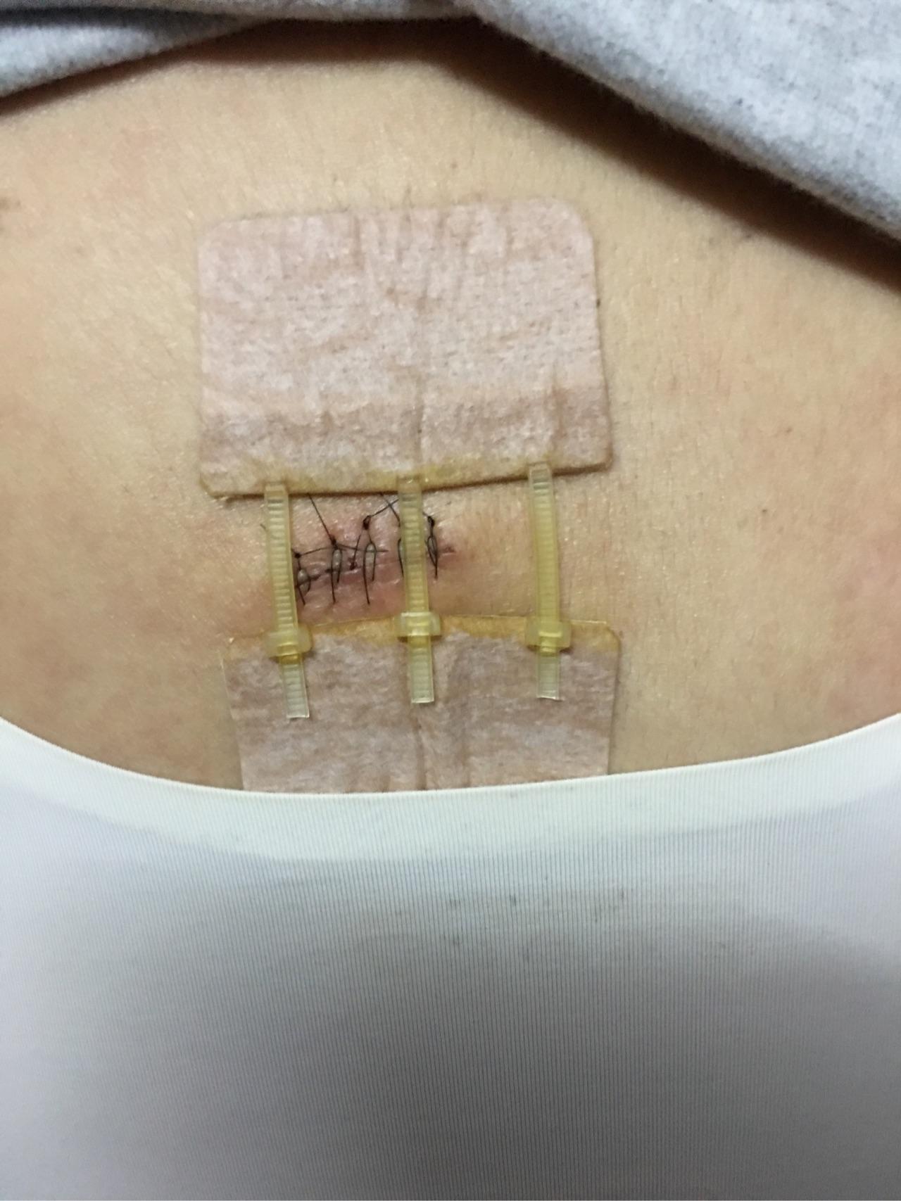 手术切痣是一种怎样的体验?