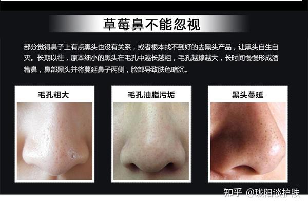 黑头是怎么形成的?为什么总是挤了又长?怎么消除? - 知乎