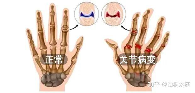 一文了解丨造成手指关节疼痛的原因有哪些