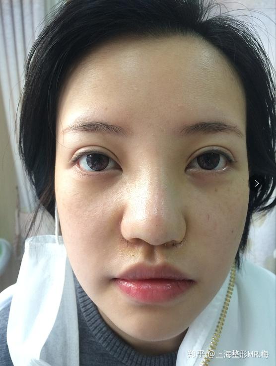 隆鼻老了会怎样有没有后遗症