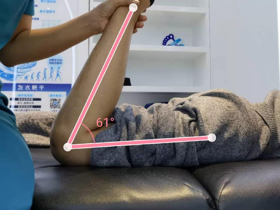 关节活动度受限明显,膝关节活动范围25°~120°03髌骨活动度受限,基本