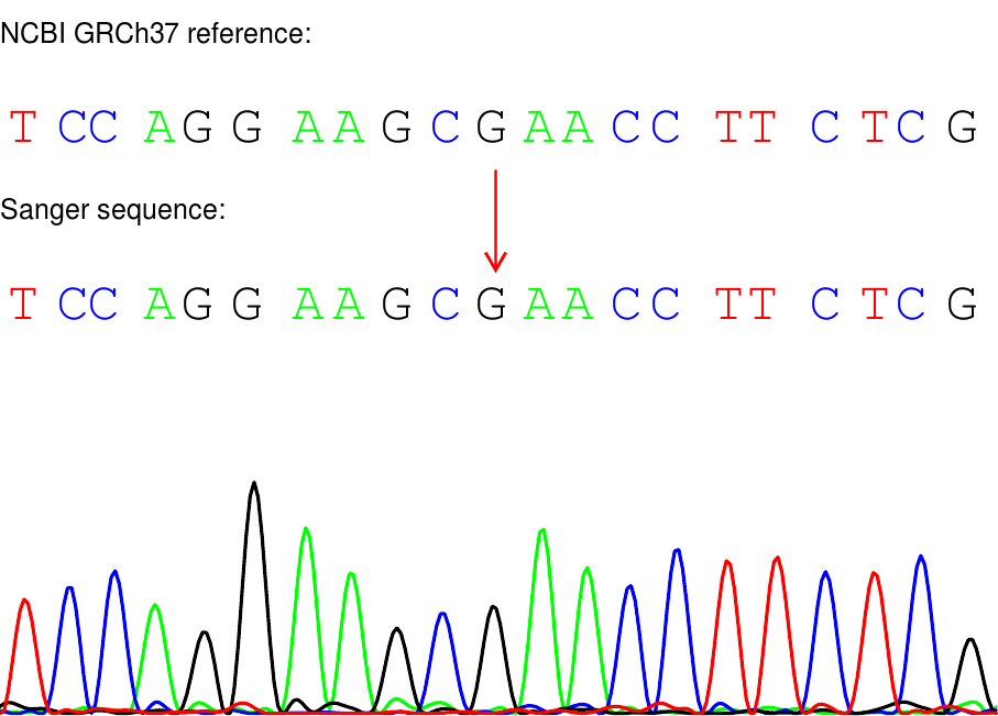 案例分享 | 基因检测辅助临床诊断罕见病——亚历山大病 - 知乎