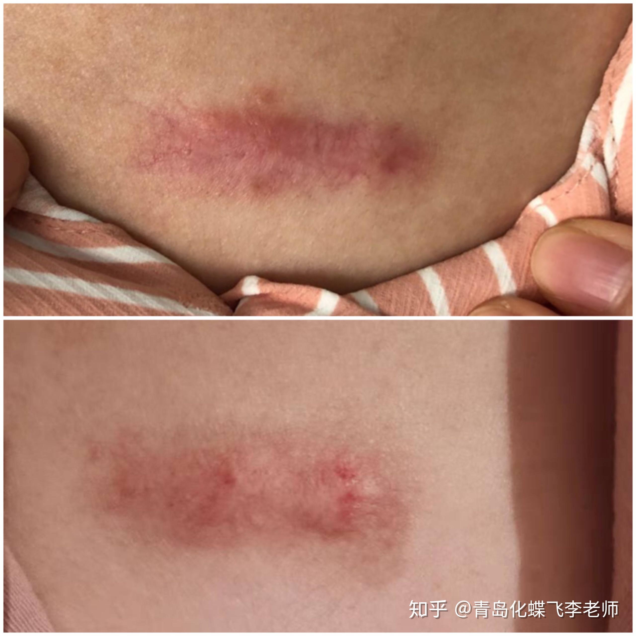 疤痕疙瘩到底有没有好办法治疗