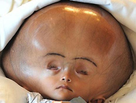 孩子头大是聪明么不仅不一定聪明很可能是病