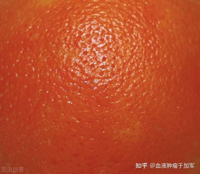 乳腺癌橘子皮图片图片