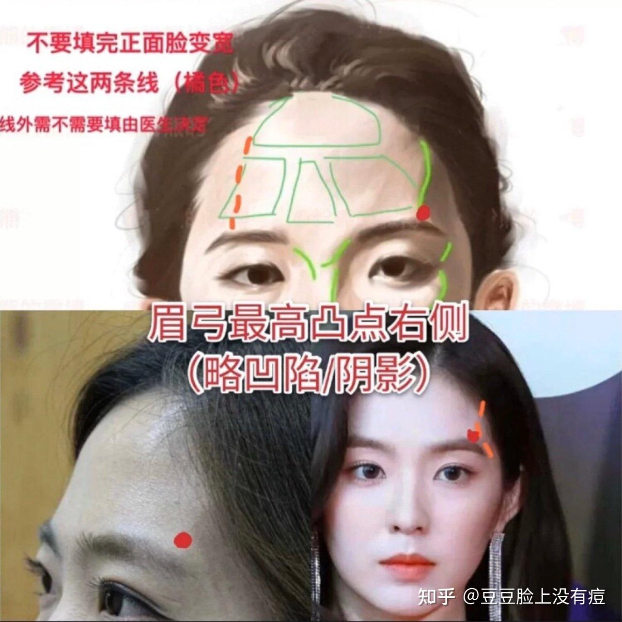 (隆鼻时眉心三角凹陷的也需要填充衔接)面部填充要点8715这些你都