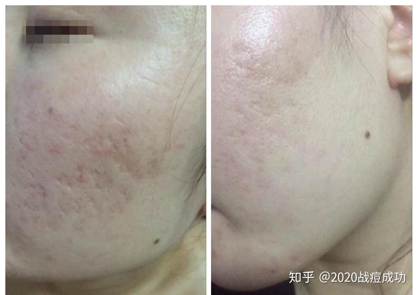 油皮的判断标准是什么? - 知乎