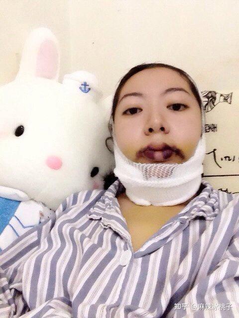 我在深圳做的正颌手术体验记录全过程日记案例
