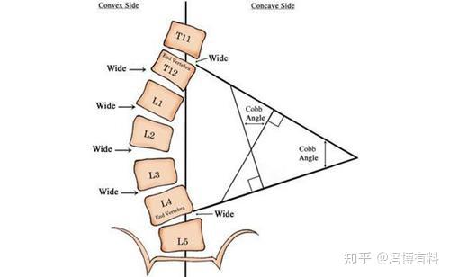 側彎脊柱上下兩端的椎體,上端椎體上終板平行線與下端椎體下終板平行