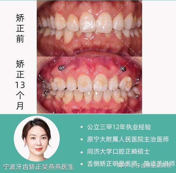 宁波牙齿矫正|舌侧正畸|下颌发育不足，凸面型案例 - 知乎