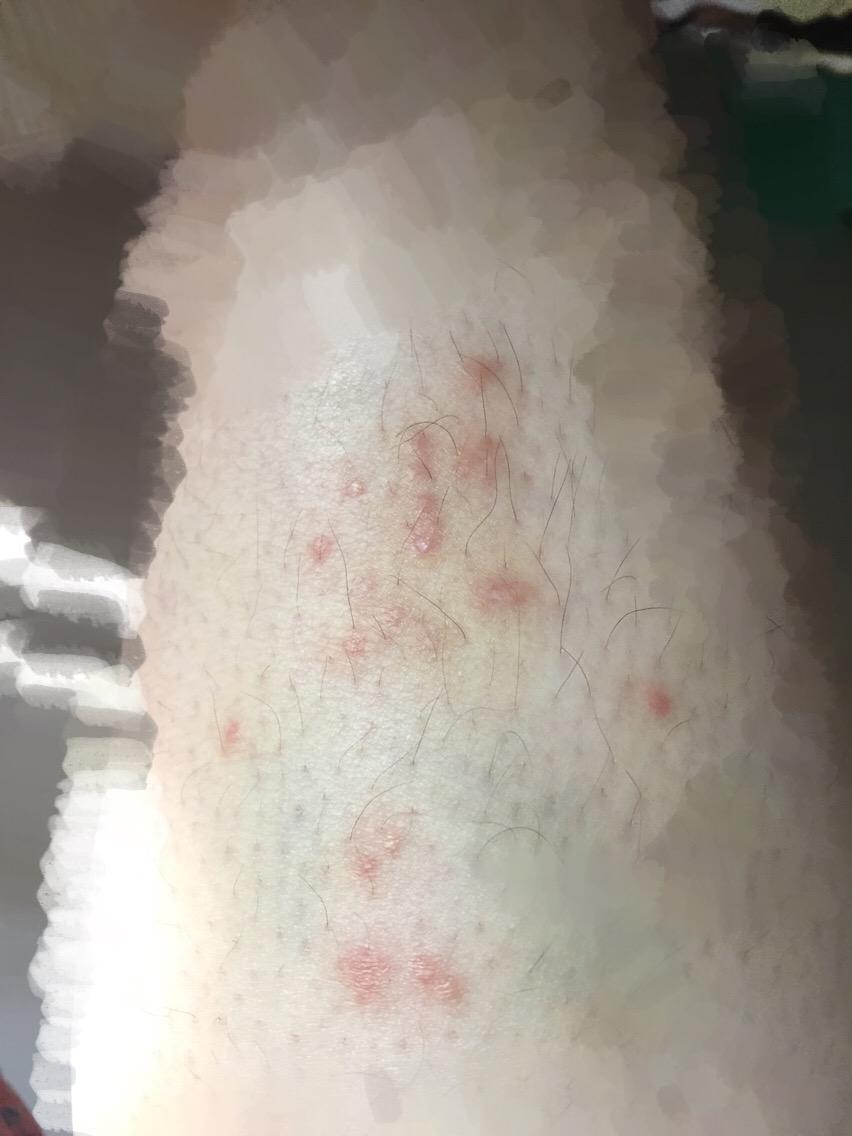 腿上皮炎复发终于不痒了可怎么去除疤痕? - 疤