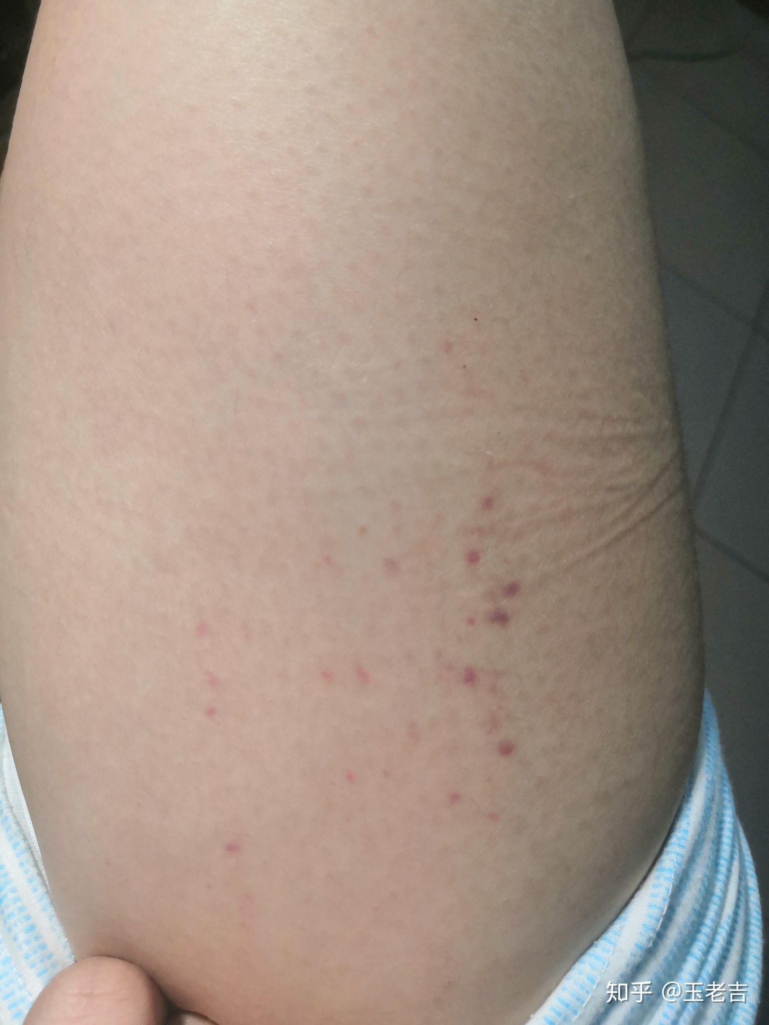 大腿上突然出现一片紫红色斑点不痛不痒是怎么了
