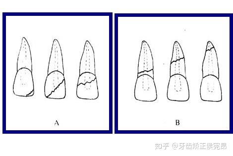 牙断了怎么办? - 知乎