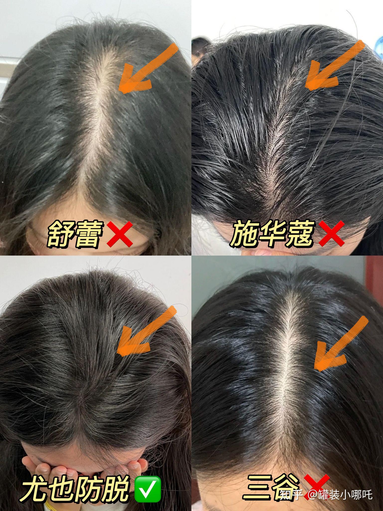 发缝越来越宽怎么办？ - 知乎