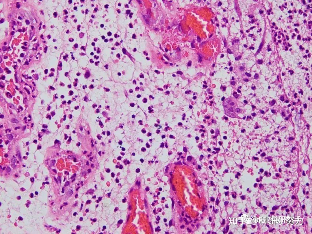 常规病理组织切片及诊断要点