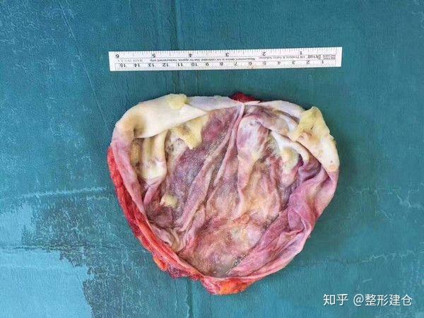 假体隆胸之包膜包膜挛缩