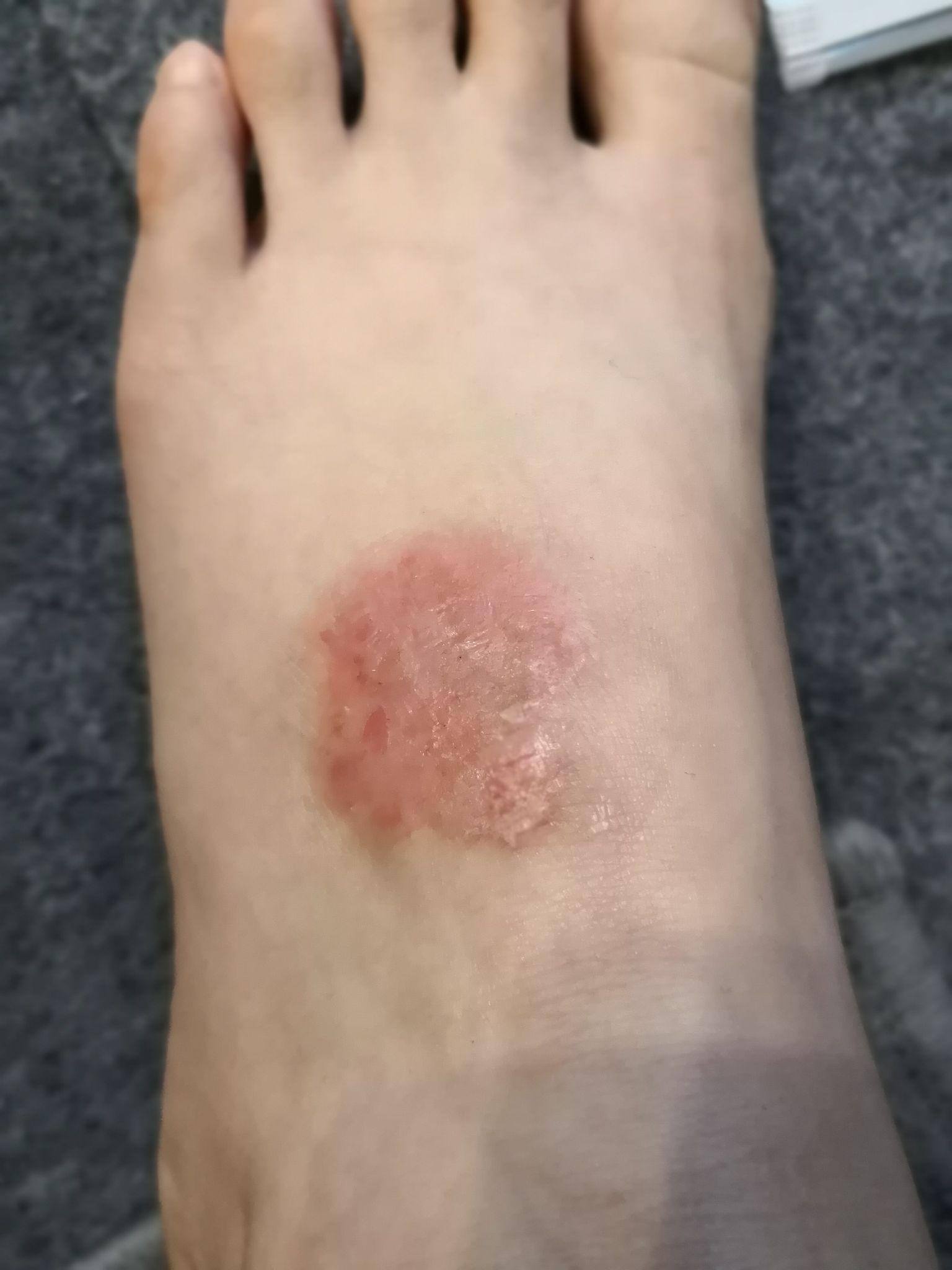 脚上有湿疹+足癣？伴有真菌感染的湿疹该怎么用药？ - 知乎