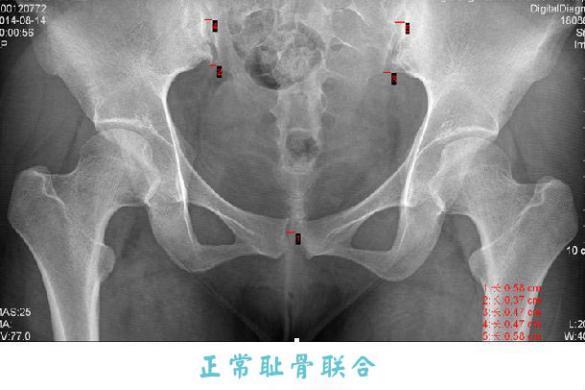 耻骨分离 一键读懂恢复骨盆五个点 知乎