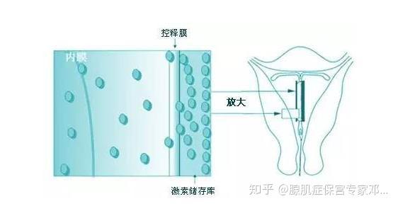 曼月樂環反覆下移推環取環怎麼抉擇