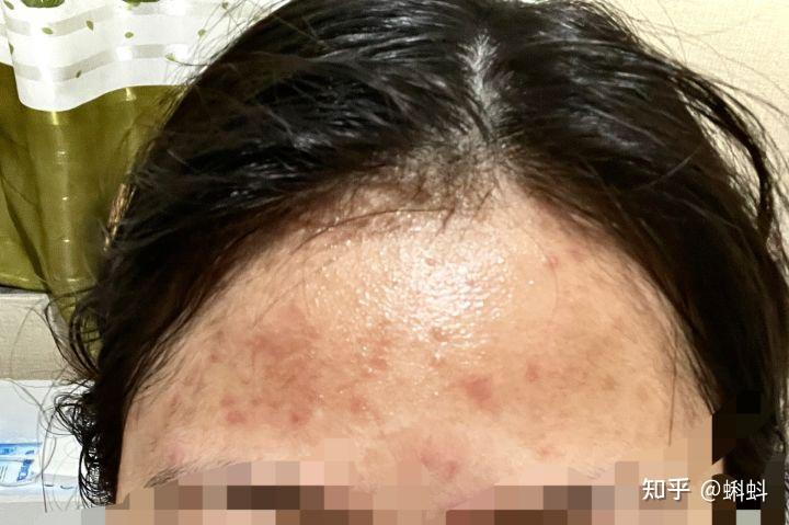 吃异维A酸鸡皮肤更明显(鸡皮肤用完维a酸之后更严重) 吃异维A酸鸡皮肤更明显(鸡皮肤用完维a酸之后更严重)