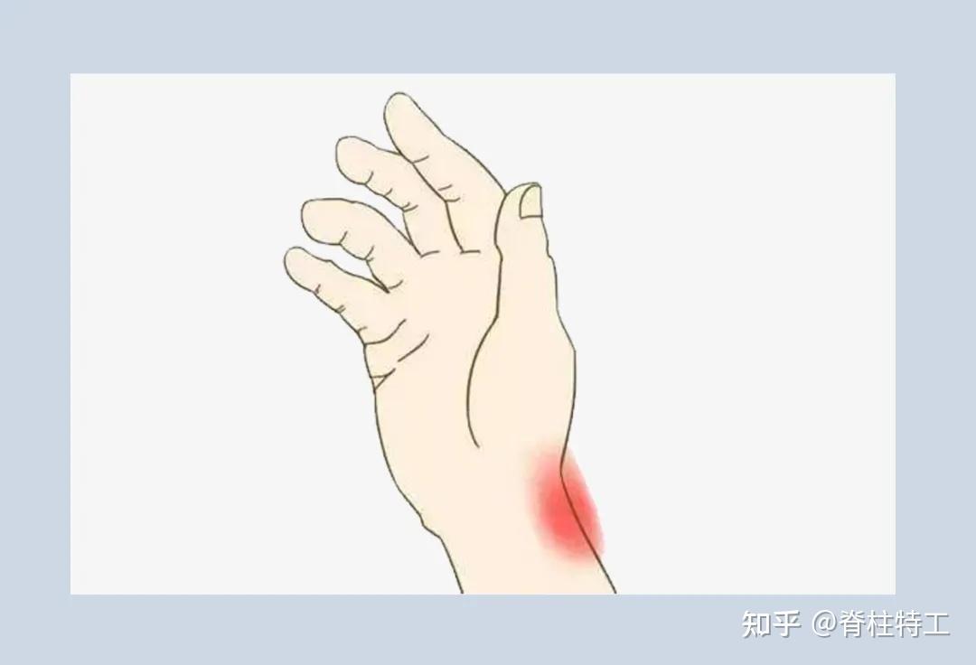 『手部疼痛地图』教你对图自查! - 知乎