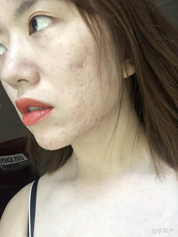 作为一个皮肤不好但是长得漂亮的女生是什么样的感受?