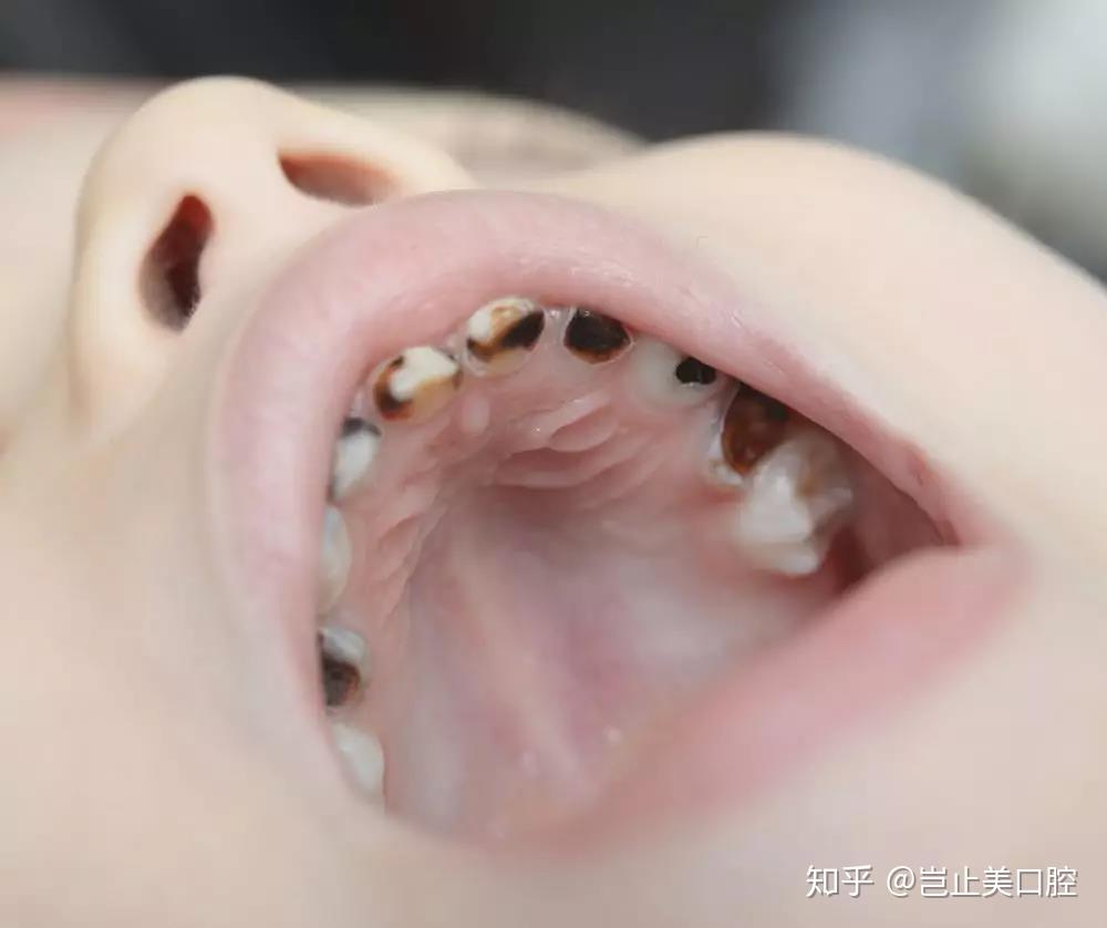 为什么要使用护牙素