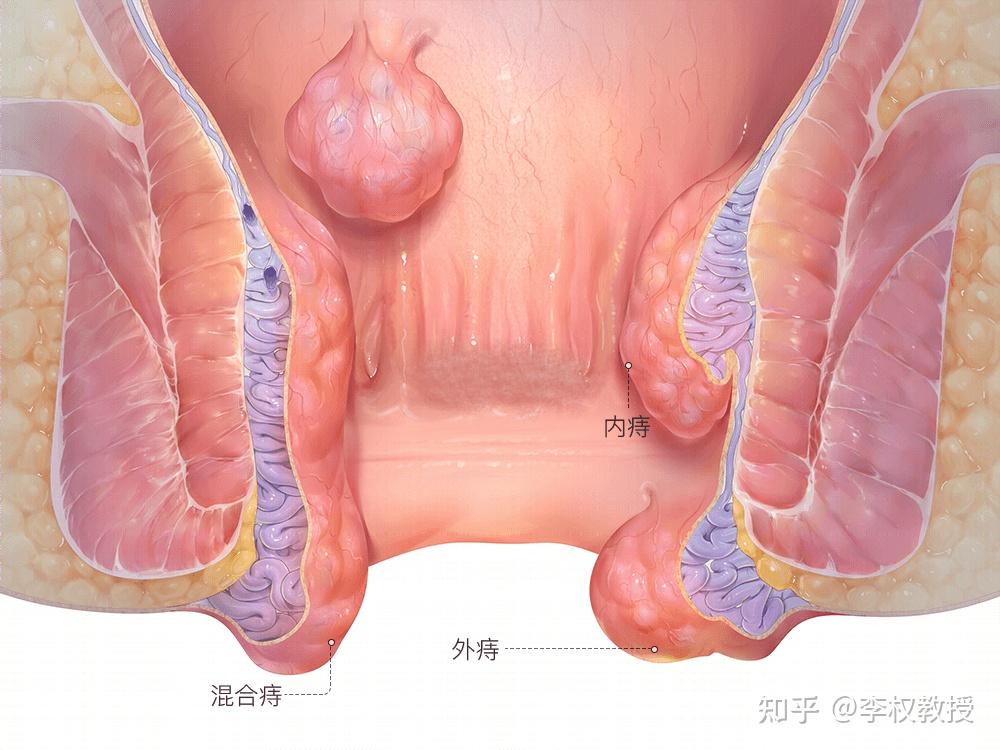 人为什么会得痔疮