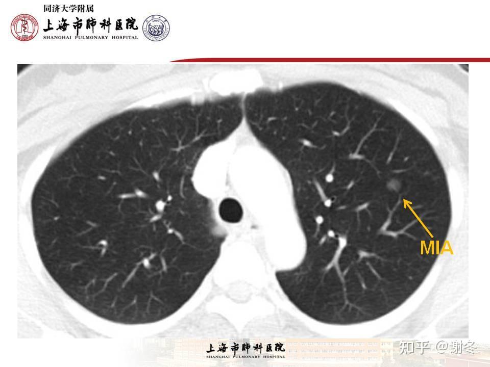 微浸润腺癌图片