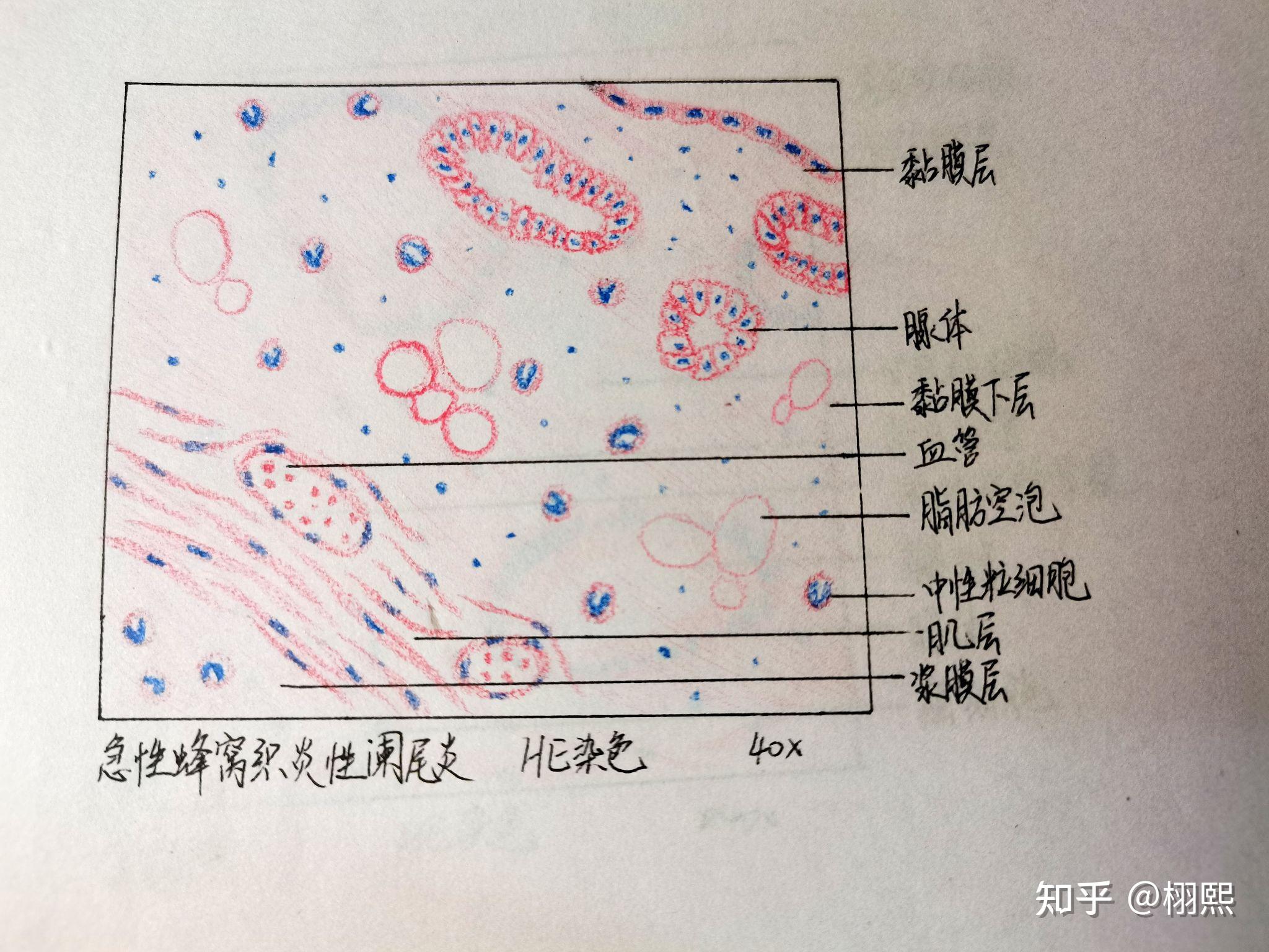 大叶性肺炎(红肝期)8胃溃疡