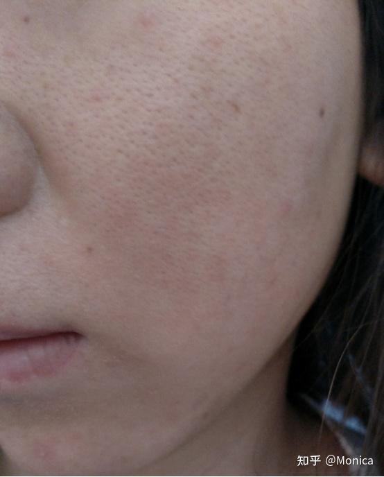 很多人在夏季的时候脸蛋一直出油以及毛孔粗大夏季出油毛孔粗大怎么办