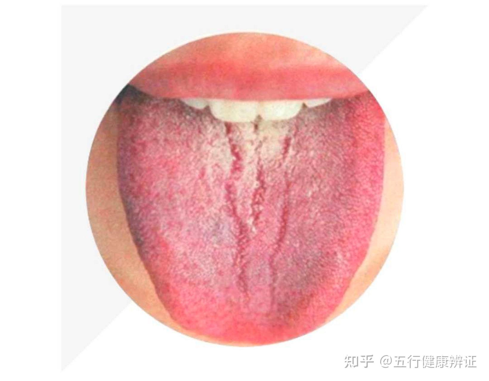 各种舌苔代表的什么？从舌苔看健康，看完之后你就成体检专家啦。 - 知乎
