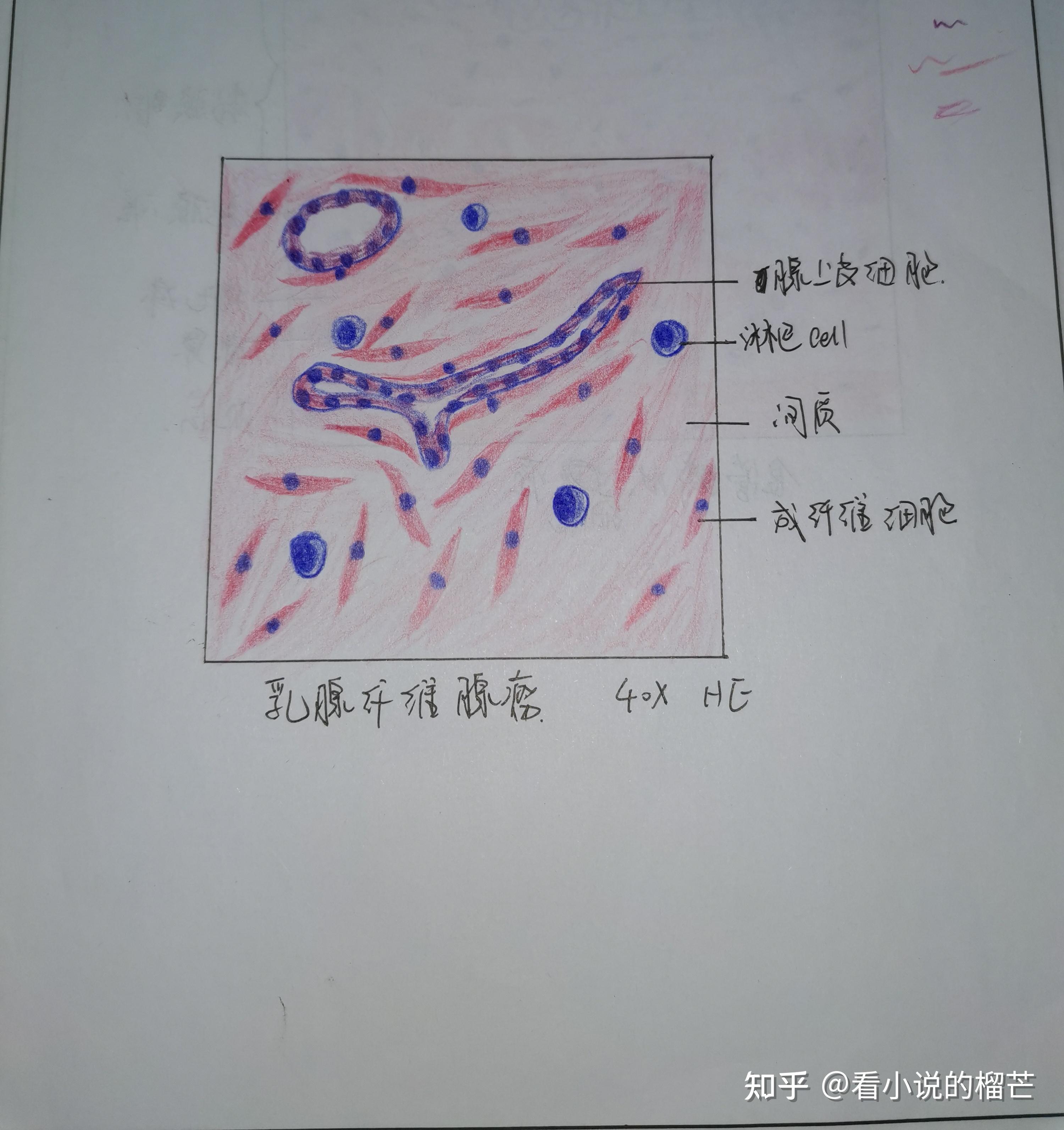 腺淋巴瘤红蓝铅笔图片
