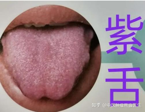 观察舌头颜色就能判断体质?来看看吧 - 知乎