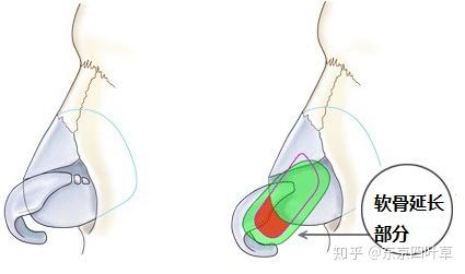 鼻中隔延长到底是个什么鬼
