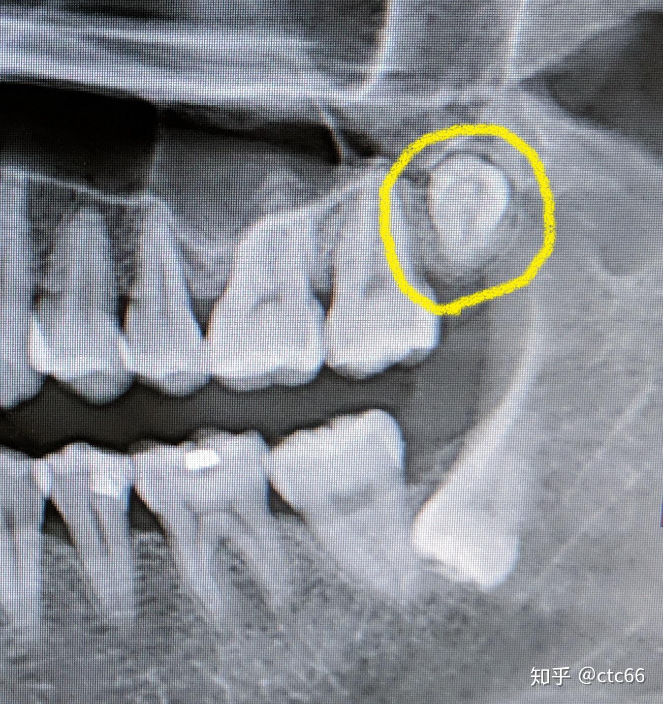 亲爱的智齿我不得不拔掉你